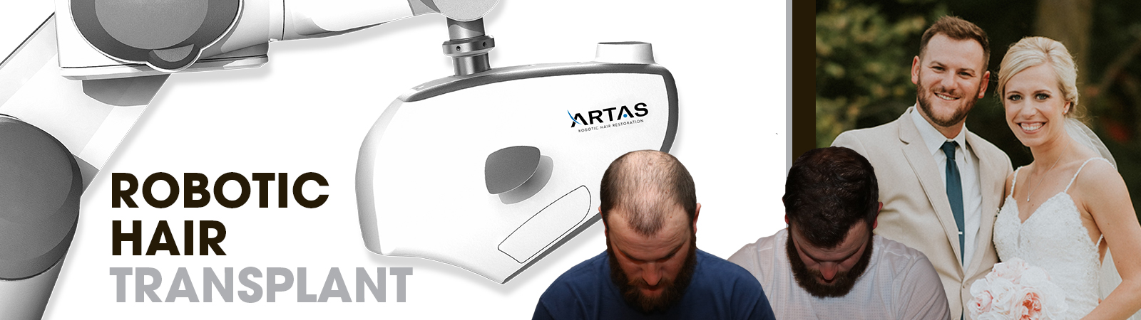 ARTAS Robotic Hair Transplant - JMISKO