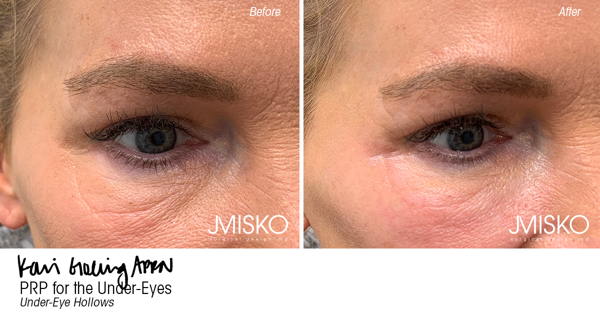 PRP for the Under-Eyes - JMISKO