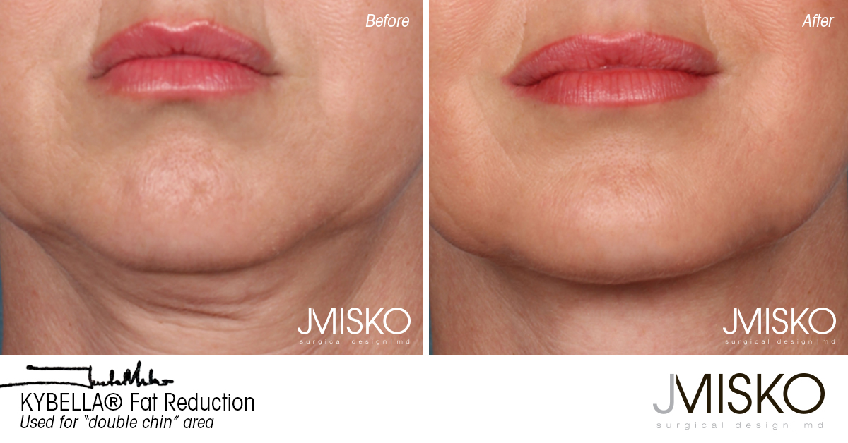 Kybella Fat Reduction Jmisko