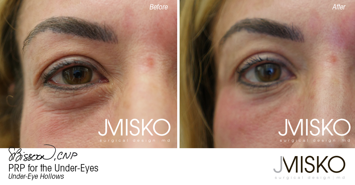 PRP for the Under-Eyes - JMISKO